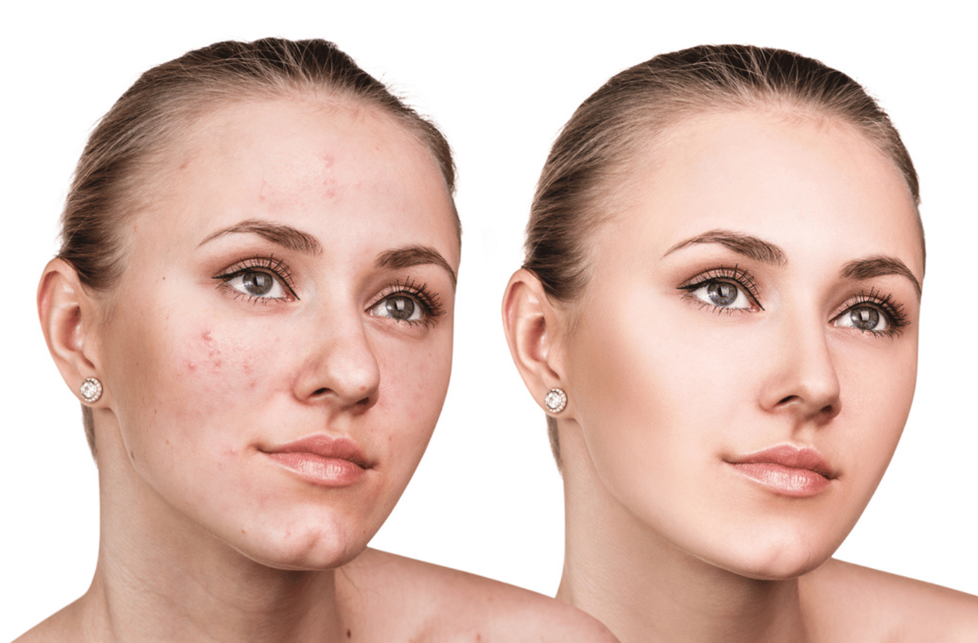 Say Goodbye to Acne Scars With the Perfect Foundation